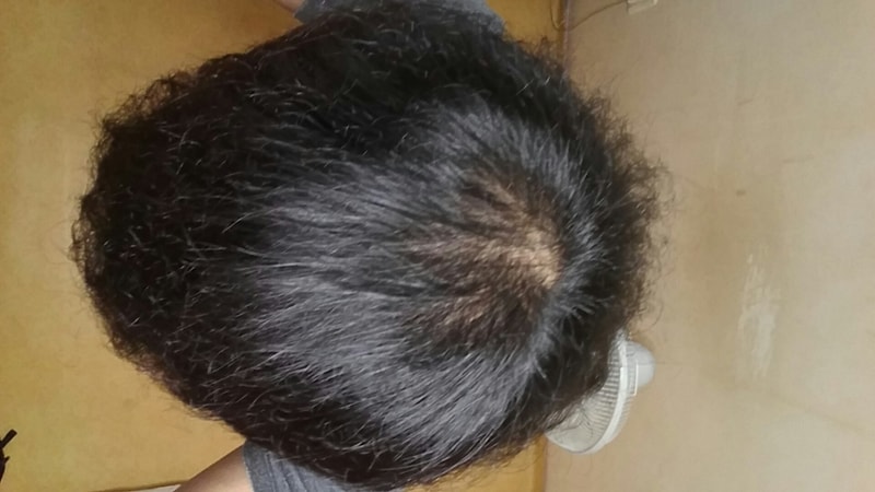 非那雄胺+米诺西地尔5个月后期。