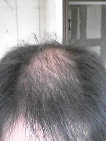 9月末~12月中旬 PFF/FFCA/其他（饮食,运动,戒烟,洗发水）后期