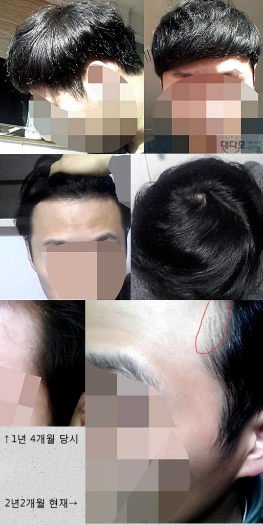 프로페시아 약 2년 2개월 복용중입니다.