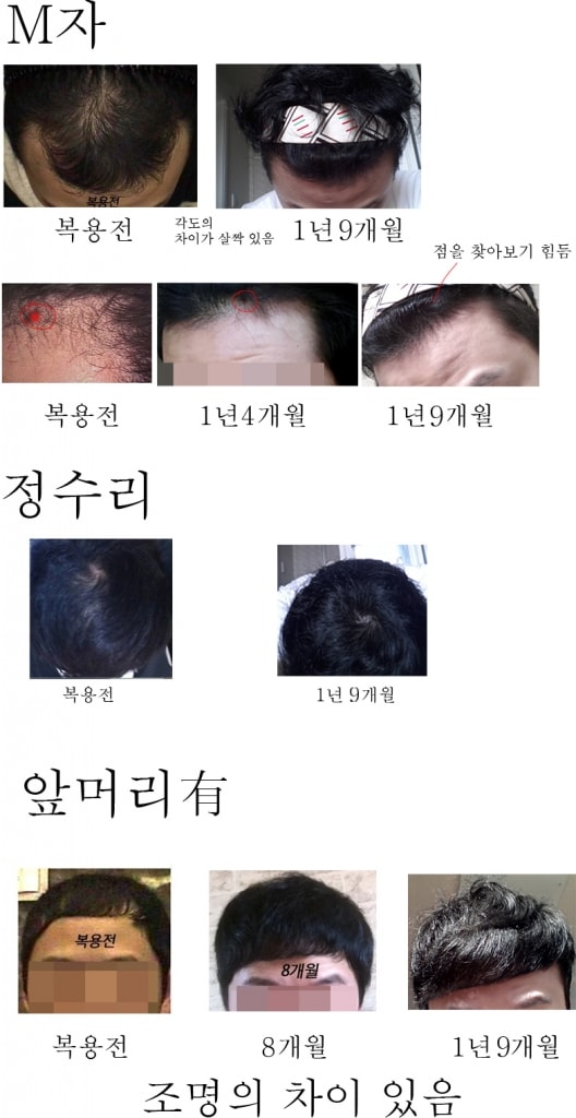 프로페시아 약 1년9개월 복용중입니다.