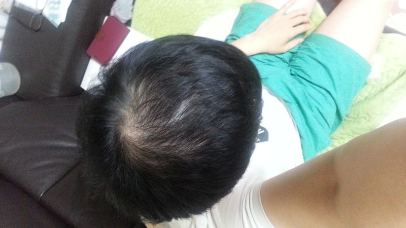 6개월 프로페시아 후기