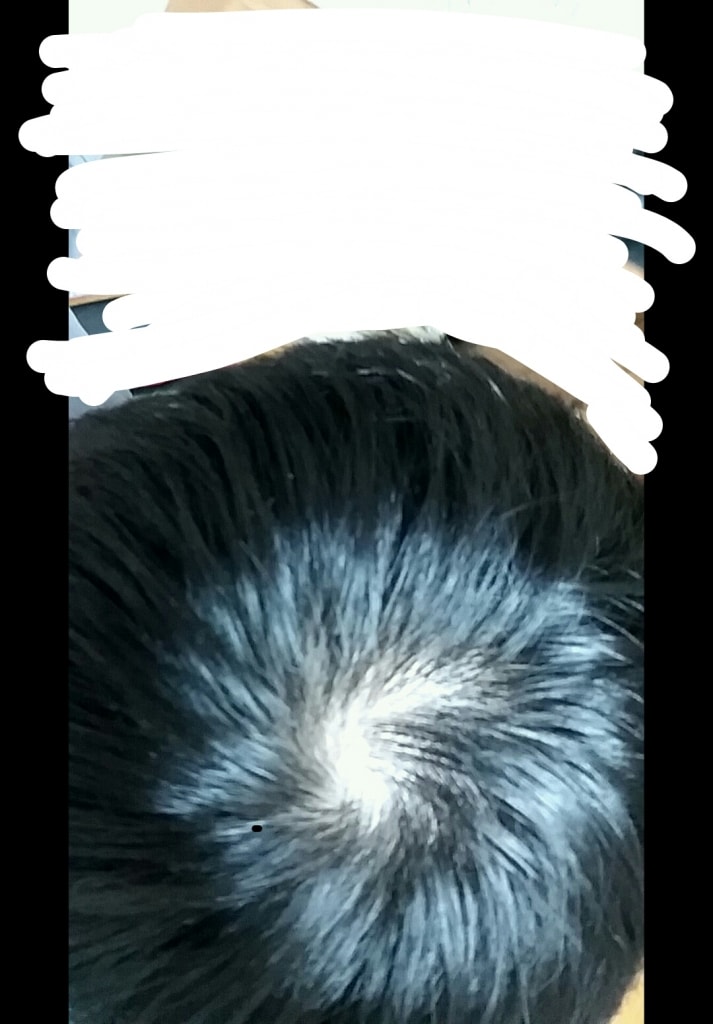 피나스테리드 145일차 후기 남겨요.