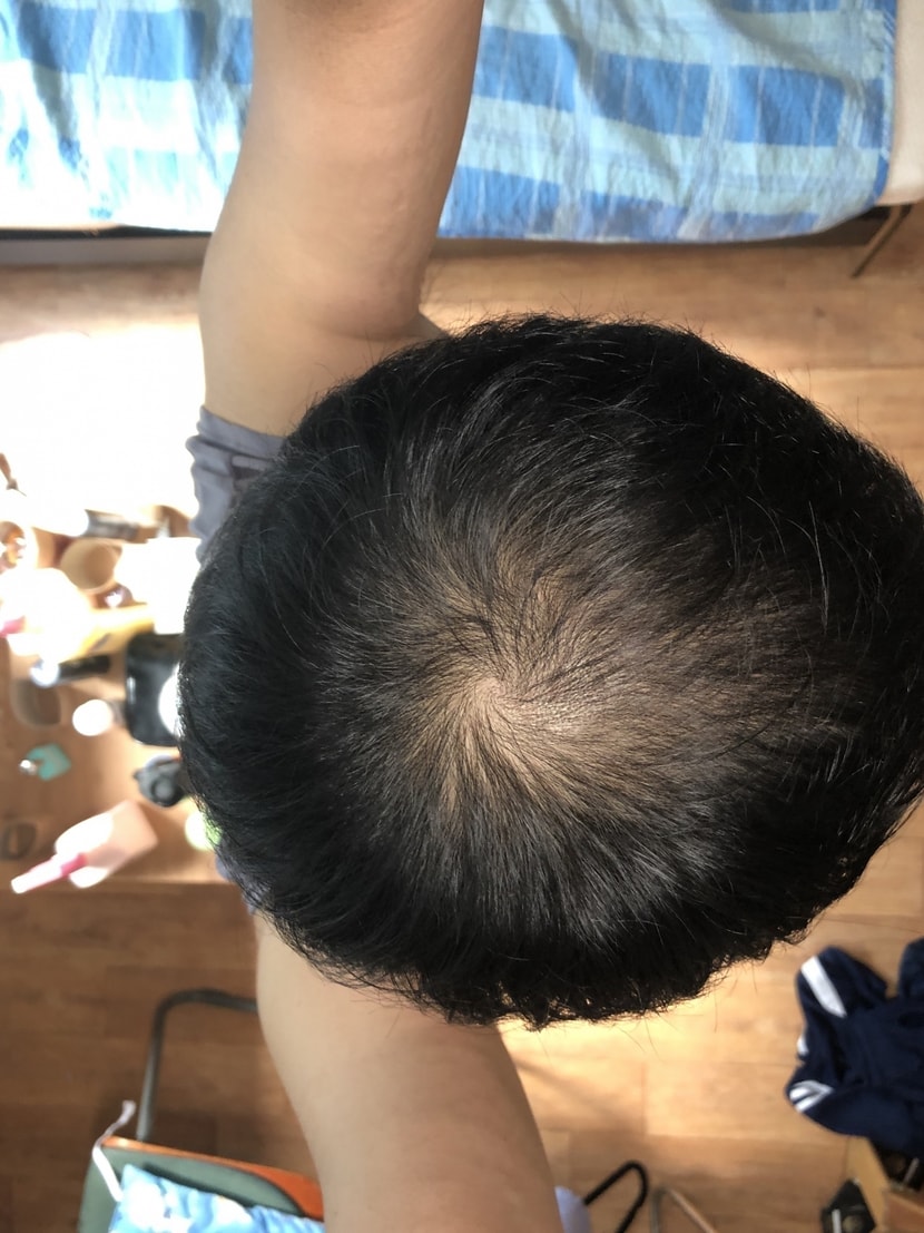 로게인폼 1통