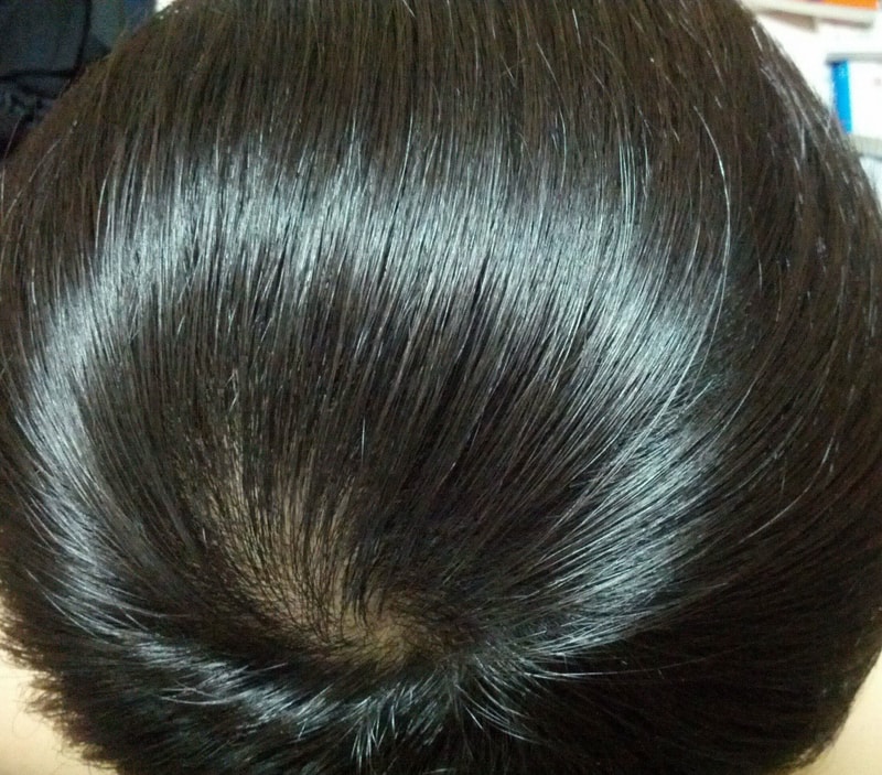 피나스테리드 3개월차