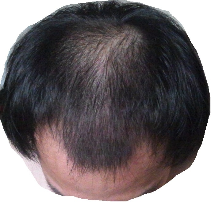Propecia + Minoxidil 5% 6个月使用后记