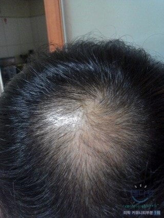 프로스카 14개월 후기.