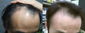복용전 ==&gt; 3개월후 비교샷