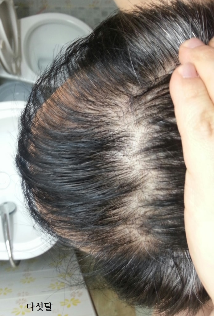 프로스카 5달 복용 후기입니다.