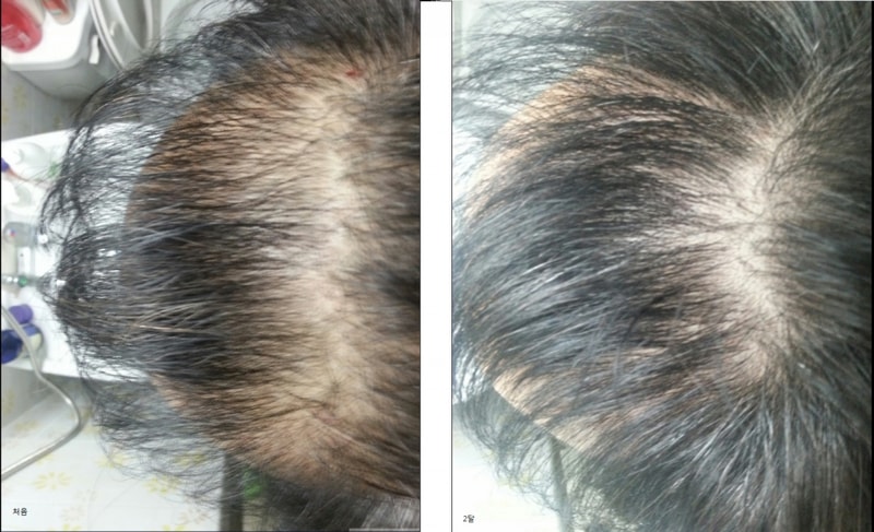 프로스카 2달 복용 후기입니다.