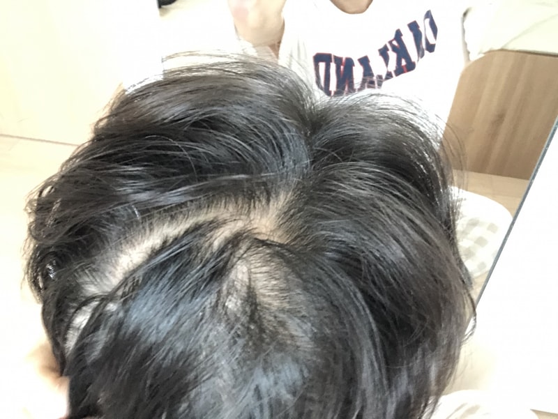 탈모로 고통받는 20대 후반입니다