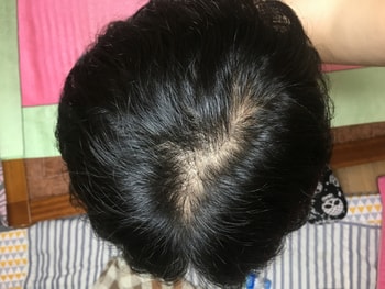 약 처방 받은날 가르마 넘겼을때