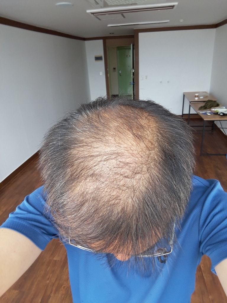 2017.09.12 (약 복용3개월후)