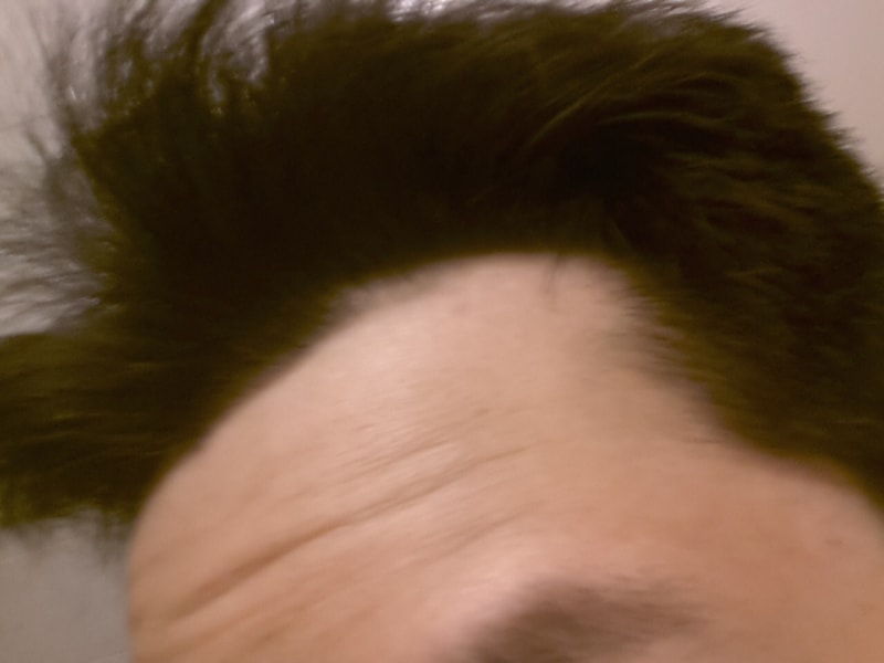 服用9个月的 Abbotte Vegeter M字头治疗后记