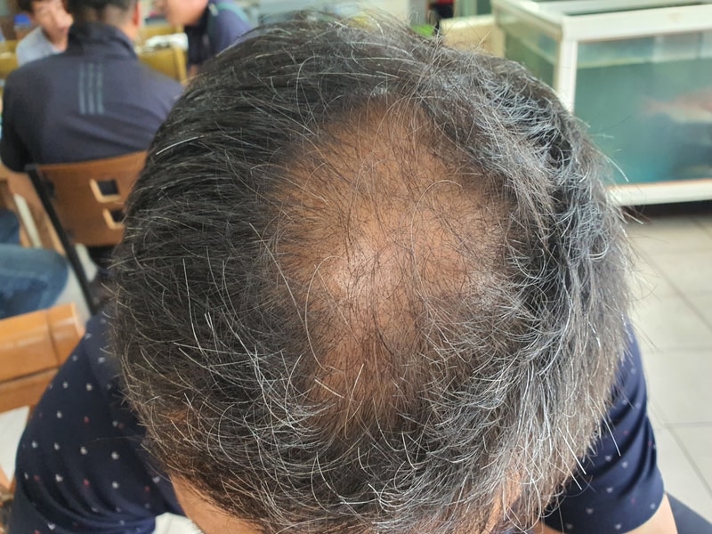 Results of 6 months of taking Sangju 00 Pharmacy's hair loss medication