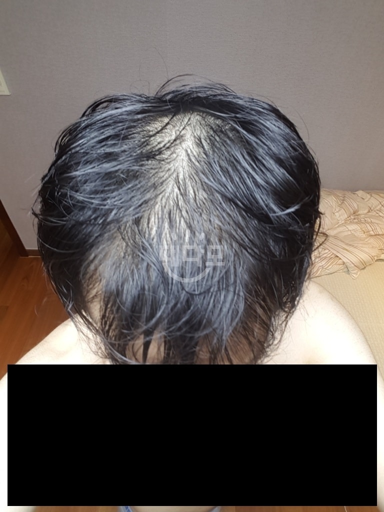 아보다트+마이녹실 5% 8개월 좀 넘었습니다(머리 말린 사진 추가)