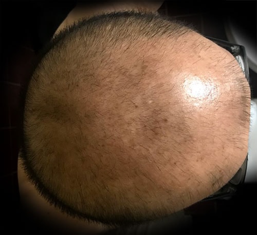 [Profesia + Minok + Biotin] It's been 3 months. at a slow pace