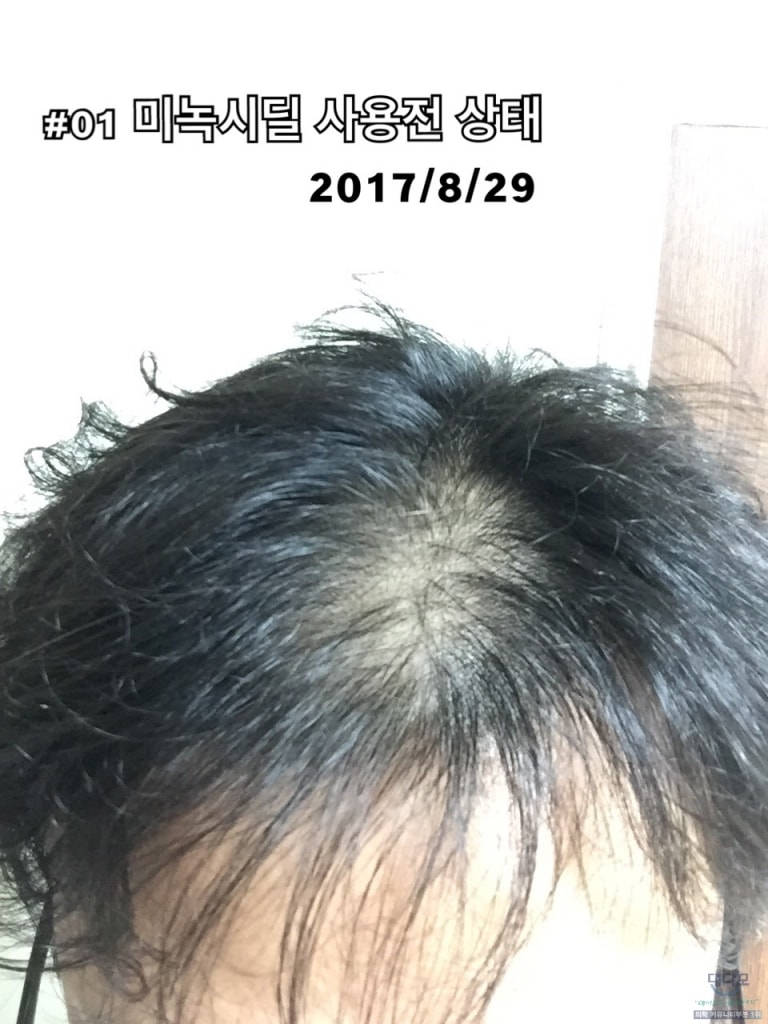 최초 미녹시딜 5%겔 사용할때 상태