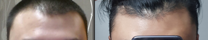 피나스테리드 미녹시딜 3년차입니다