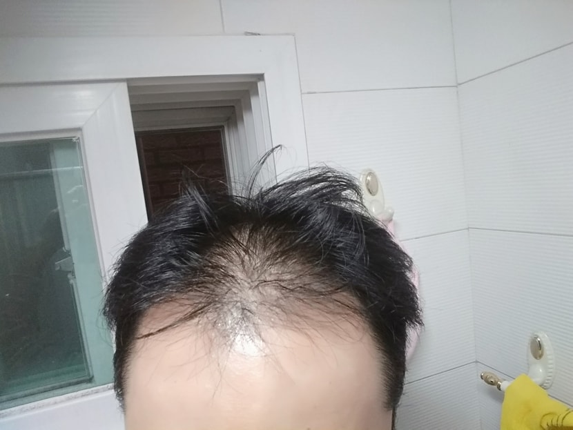 2018년11월 약 복용전