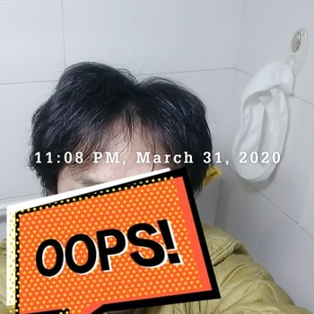 2020년 3월 ㅡ아보다트 격일 복용 1년 5개월 차