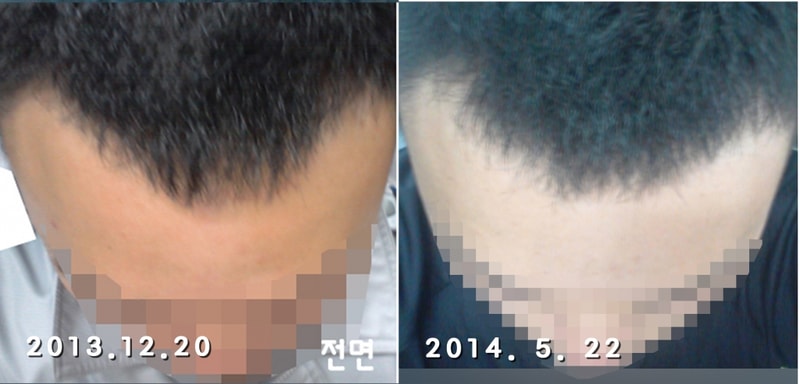 피나스테리드 6개월차 효과 못보는건가요 ?ㅜㅜ (사진)