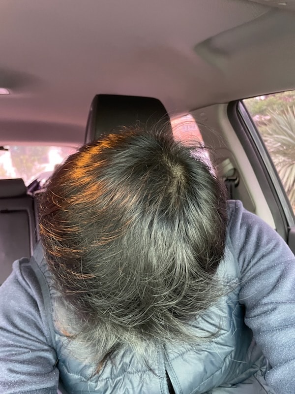 탈모약 먹기 2개월 경과