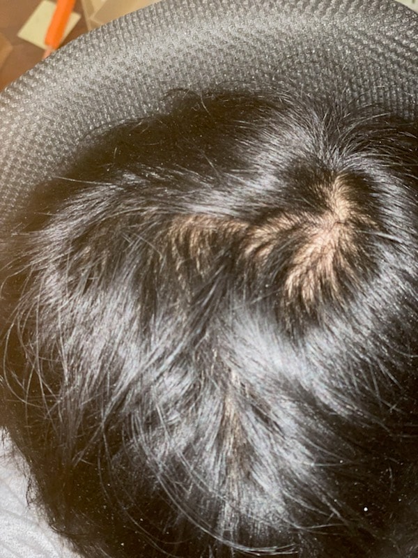 탈모약복용 1개월차