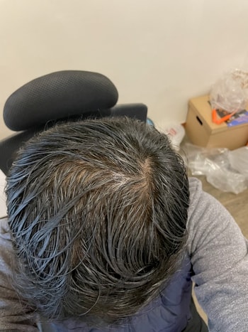 현재/ 미녹시딜 도포후