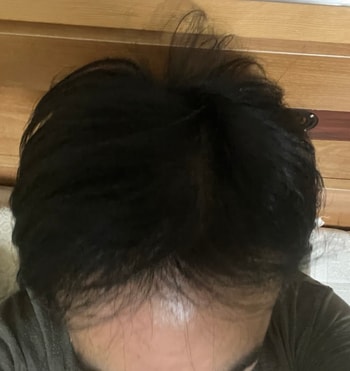 복용 1년차