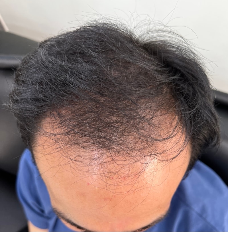 Finasteride, Minoxidil Combined Prescription 1 Year and 6 Months