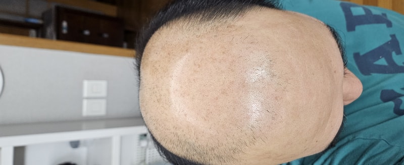 라무몰에서 아보다트 두사트 0.5 복용중입니다.