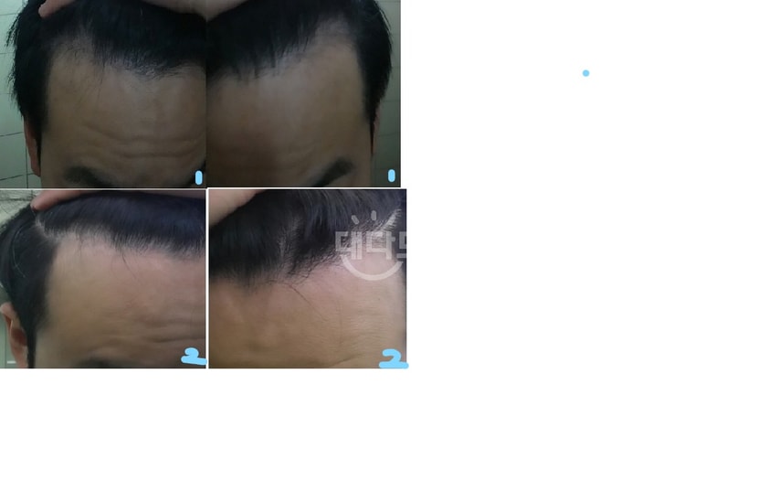 1번사진 복용전, 2번사진 프로스카 5~6개월 차
