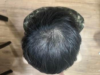 10월 18일 약 + 미녹 바로 전