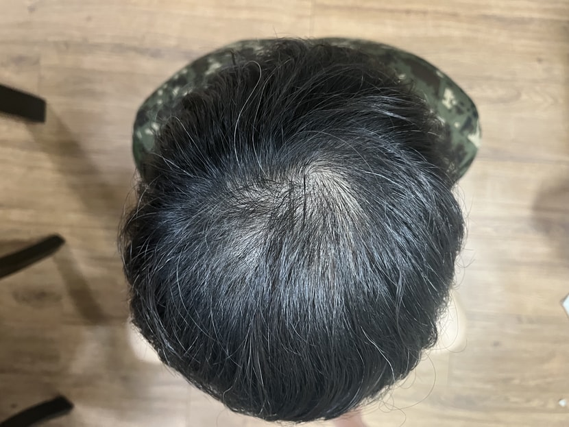 10월 18일 약 + 미녹 바로 전