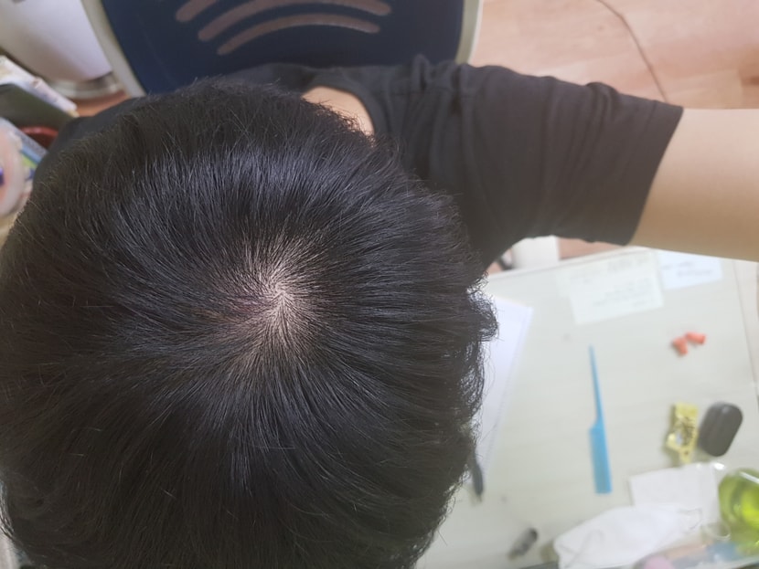 5월 9일(치료 약 8개월차) 저는 치료 초기에 효과를 정말 많이 봐서 두 사진간에 차이가 명확하진 않지만 그래도 8개월차 사진이 좀 더 호전된거 같은데 회원님들 보기엔 어떠신지 ㅎㅎ