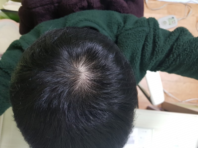 피나스테리드 + 미녹시딜 8개월