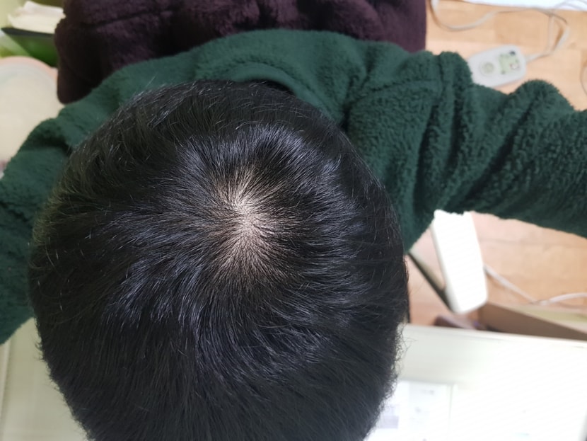 2월 7일(치료 약 5개월차)