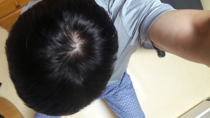 Pinasteride 7 Months