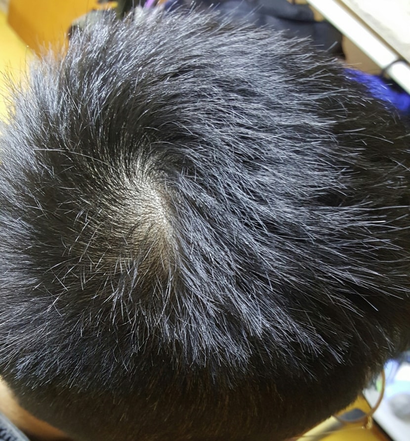 플래시 안터트리고 찍은 정수리 사진입니다.