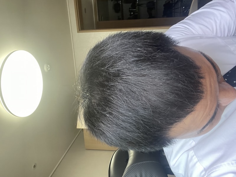 久しぶりにデュタステリドの体験談でお伺いします。