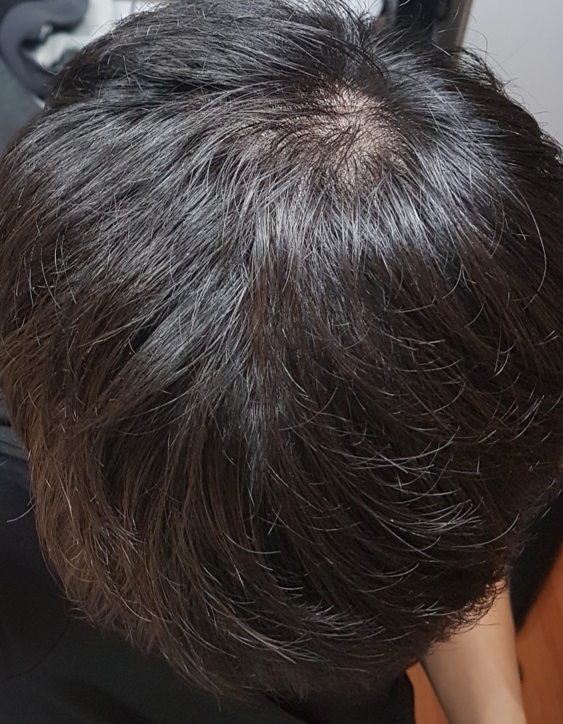 이사진은 제가 처음 탈모를 인지했을 때의 사진입니다 작년 5월경이고 탈모가 맞다고 확신했습니다. 예전엔 정수리가 비지 않앜ㅅ거든요