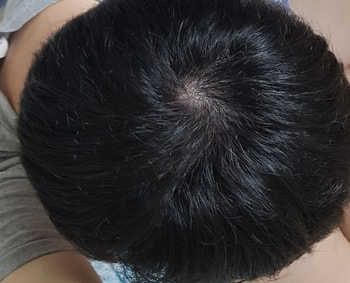 이게 오늘사진, 오늘은 약 복용한지 5개월 하고 25일째 되는 날입니다. 단 하루도 빠지지 않고 매일 아침에 약을 먹었습니다. 아직 탈모로 보시는 분들이 있을지도 모르겠지만 유지를 기대했는데 그 이상을 해준 것 같아서 너무 행복합니다.