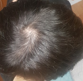 12월 중순, 5개월차입니다. 이때까지만 해도 약효랄게 전혀 보이지를 않아 그냥 포기했었습니다. 약을 먹기는 먹지만 약에 전혀 기대하지 않았죠.