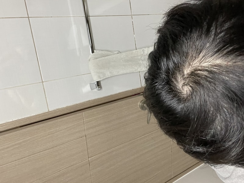 프로스카 1/4조각, 로게인폼 6개월후기