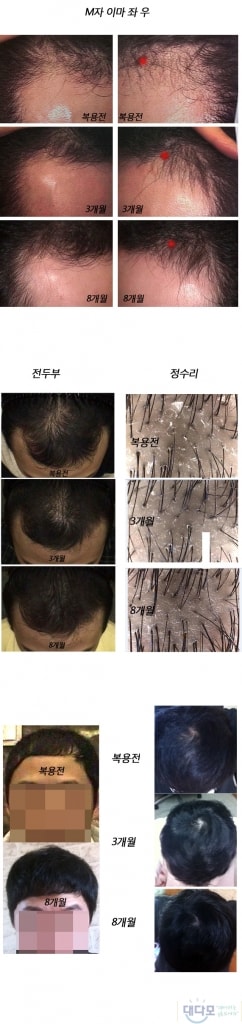 프로페시아 약 1년4개월 복용중입니다.