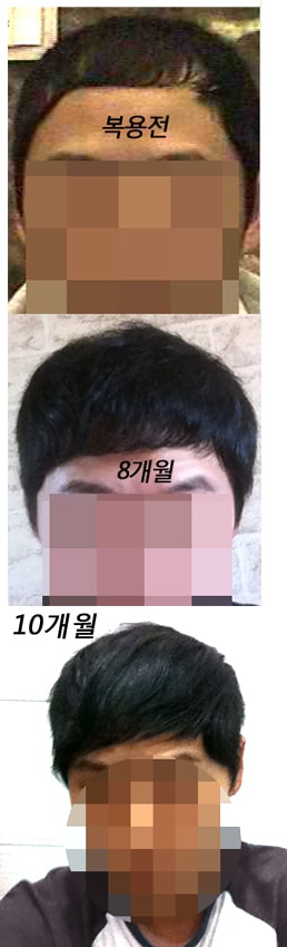 프로페시아 10개월 복용중입니다.