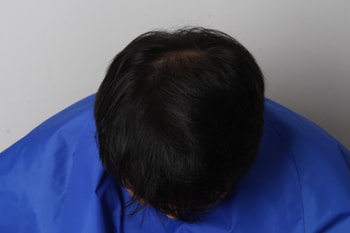 17년 11월 2차 메조치료 끝