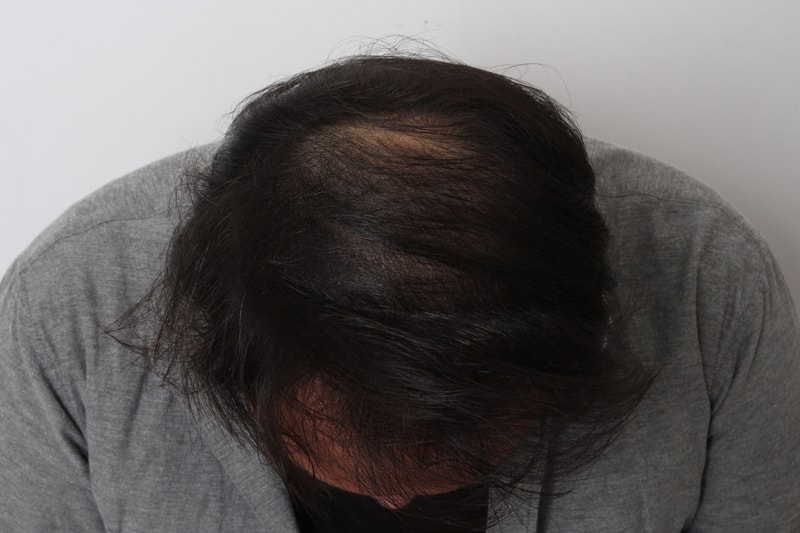 There is no cure for hair loss.