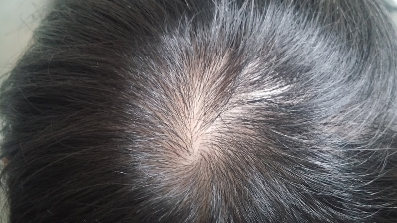 alpesin洗发水+液体+prosca 9个月使用后记