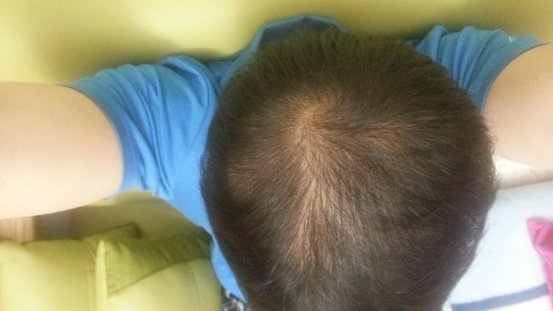 avote + minoxidil 6个月